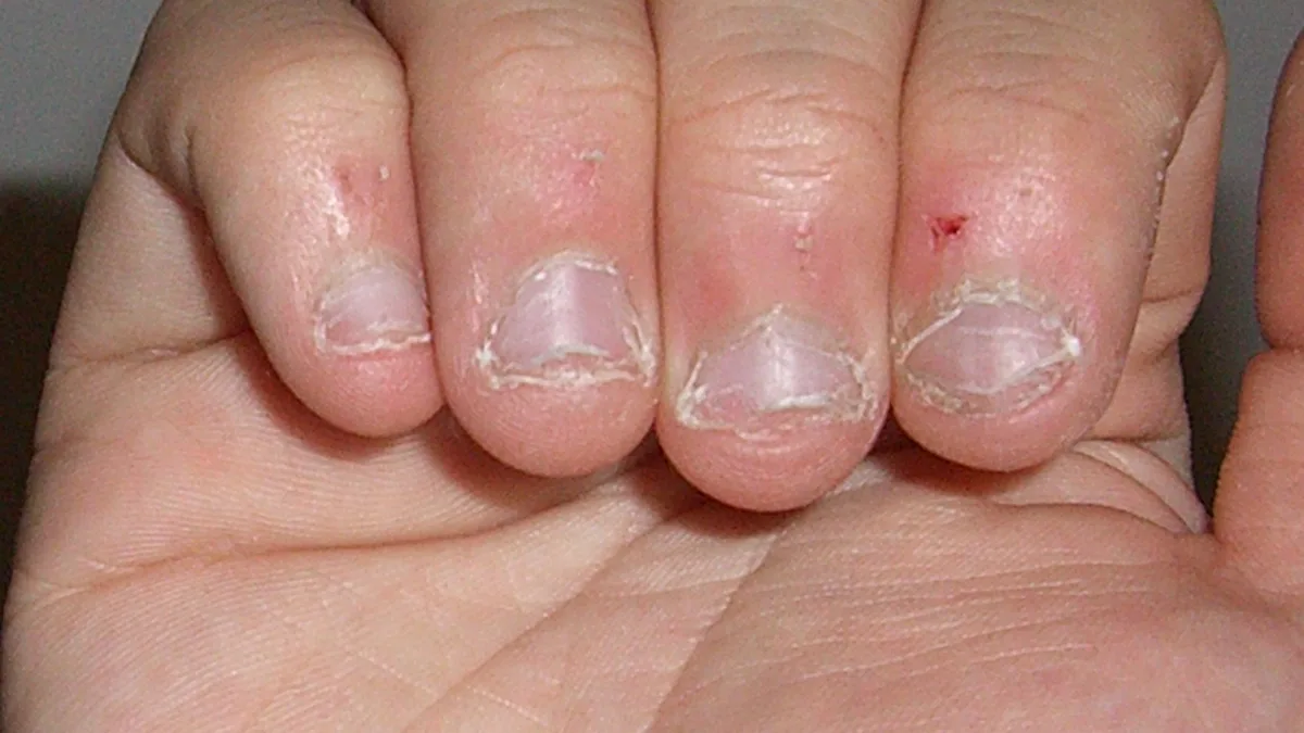 Nail Biting And Picking